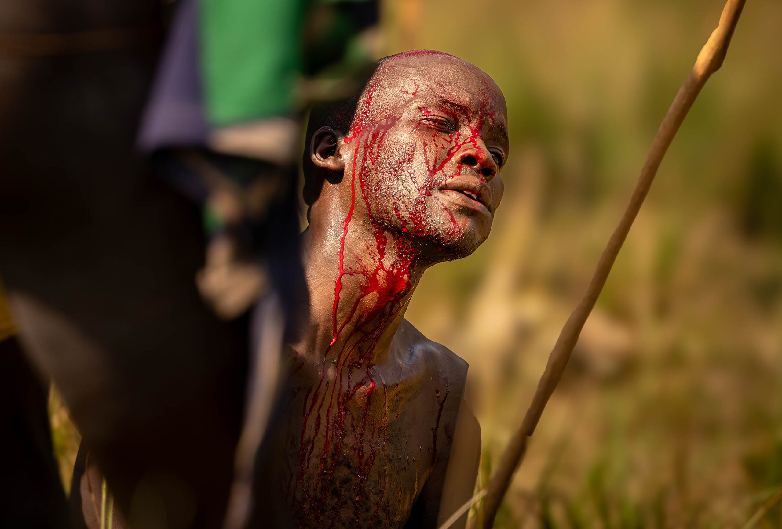 Man with a bleeding head wound after a donga stick fight, Omo Valley, Ethiopia